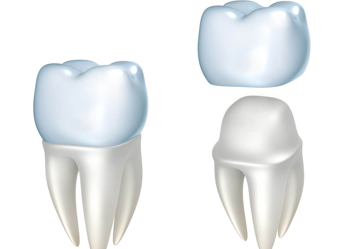 Porcelain Dental Crown in Baltimore MD Area